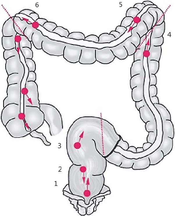 what problems does a tortuous colon cause