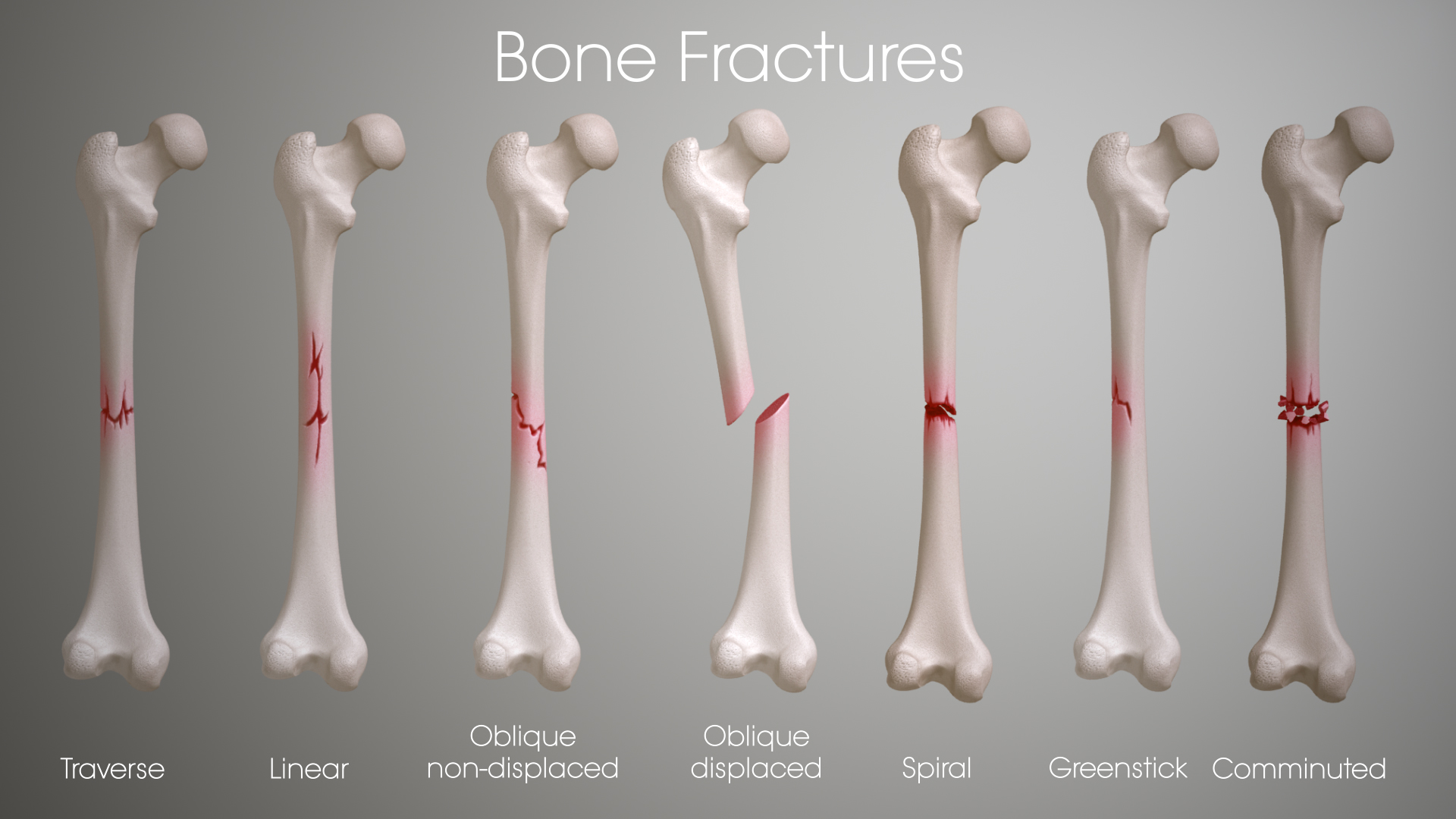 how much pressure does it take to break a bone