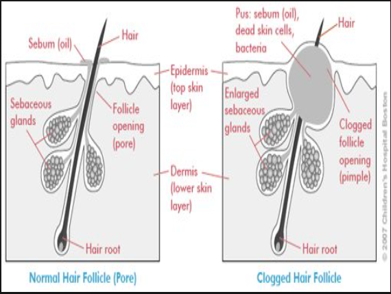 clogged pores on breasts