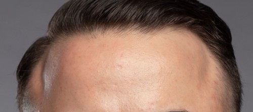 dent in forehead