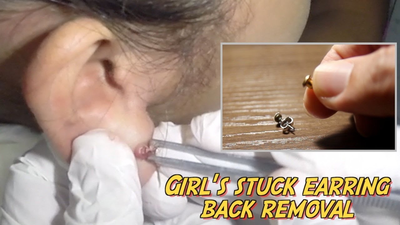 earring back stuck in ear